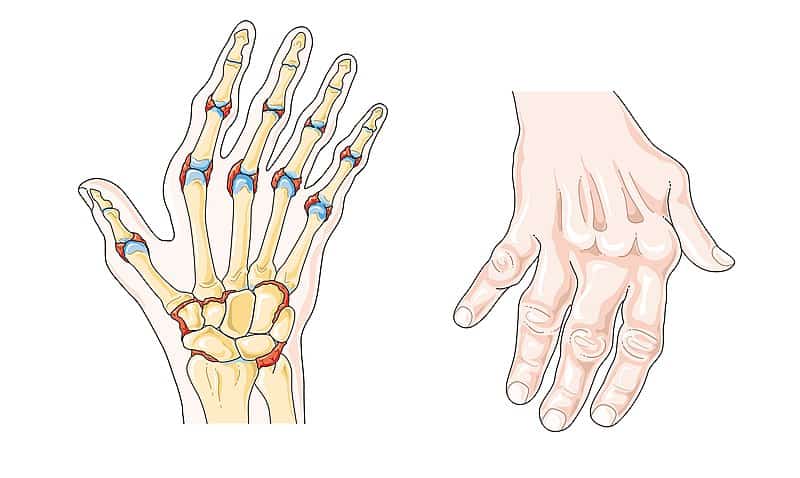 How to Get Relief from Arthritis Pain? – Countfit